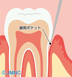 歯周ポケットとは